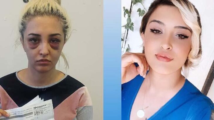 Sevgilisi bu hale getirdi: Şikayetini geri çekti