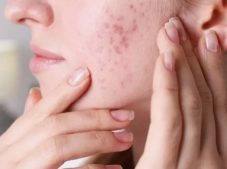 Cilt sorunlarına son! Pürüzsüz bir cilde sahip olmak bu kadar kolay