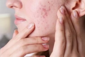 Cilt sorunlarına son! Pürüzsüz bir cilde sahip olmak bu kadar kolay