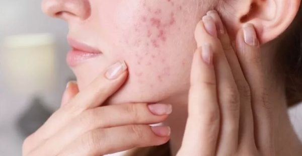 Cilt sorunlarına son! Pürüzsüz bir cilde sahip olmak bu kadar kolay