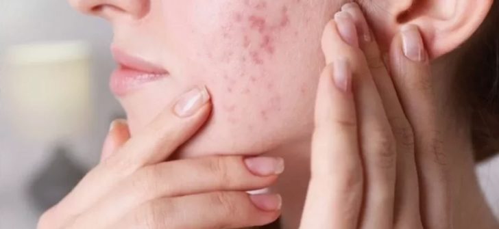 Cilt sorunlarına son! Pürüzsüz bir cilde sahip olmak bu kadar kolay