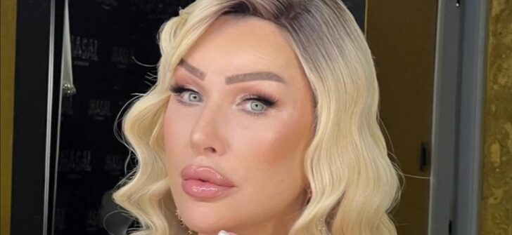 Seda Sayan yüzündeki şişliğin nedenini açıkladı