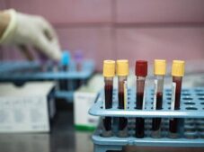 Dünyada her yıl 20 milyon, Türkiye’de ise 240 bin kişi kanser tanısı alıyor