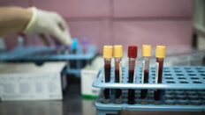 Dünyada her yıl 20 milyon, Türkiye’de ise 240 bin kişi kanser tanısı alıyor